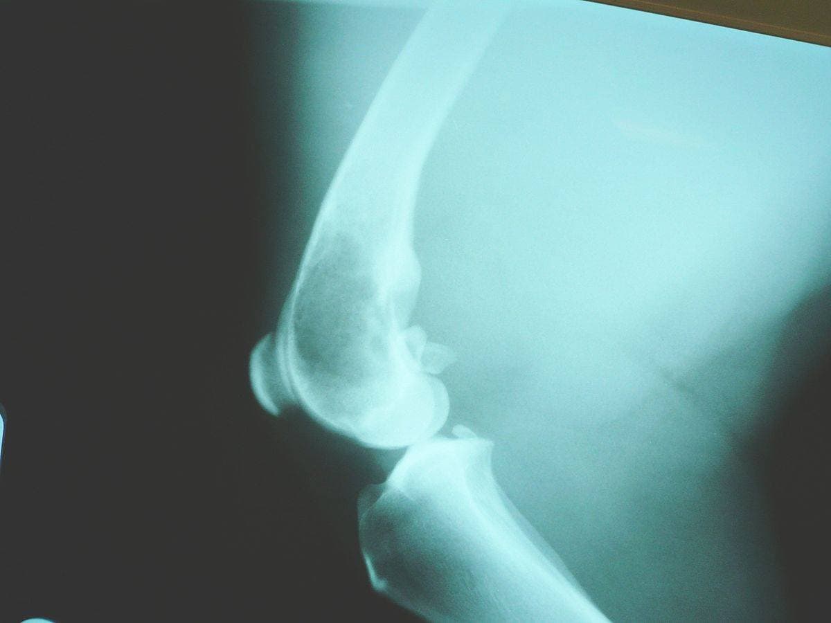 Canine osteosarcoma