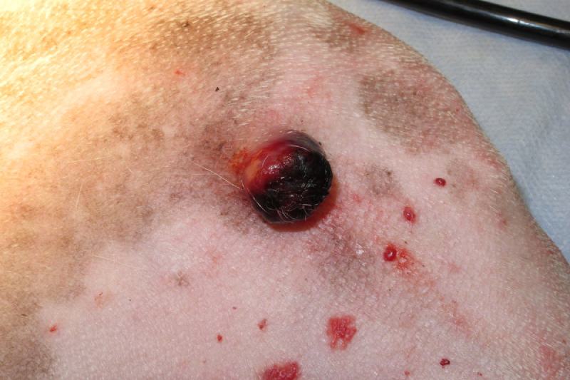 HEMANGIOSARCOMA Cutaneous HSA