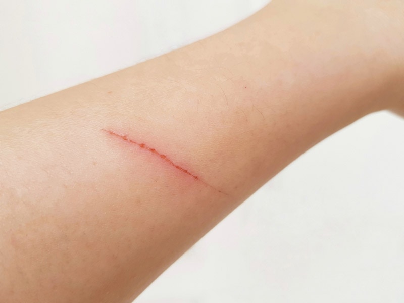 cat or dog scratch on arm