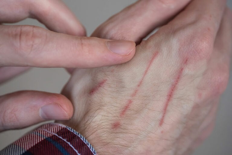 How To Treat a Cat Scratch: 8 Vet Approved Tips | Hepper Pet Resources