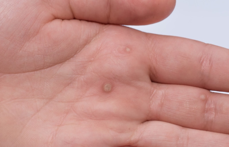 Warts appearing on a hand