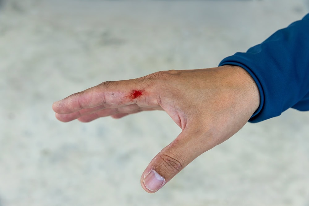 Dog bite wound and blood on hand