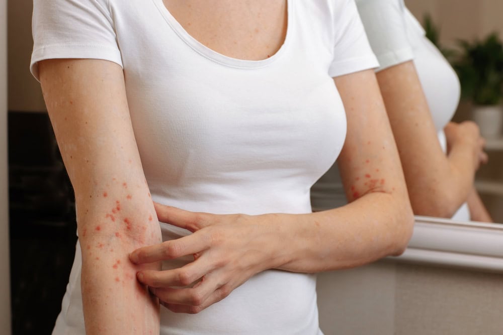 Itching and scabies in skin